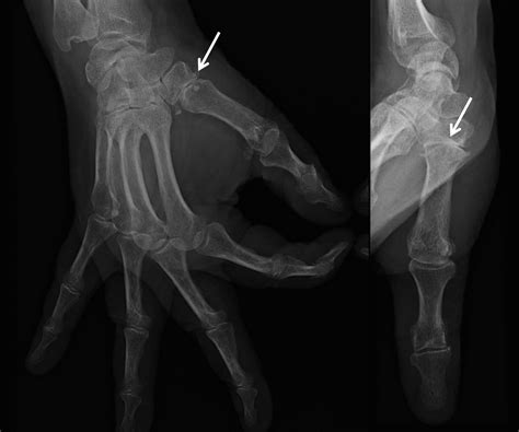 Rhizarthrose Arthrose Du Pouce Clinique Ost O Articulaire Des