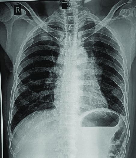 Chest X Ray Pa View Showing Mediastinal Mass Pa Posteroanterior Download Scientific Diagram