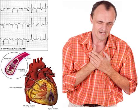 Nuestro Cuerpo Y Nuestra Salud Infarto De Miocardio