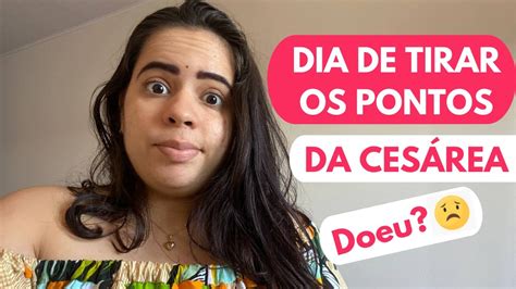 Tirei Os Pontos E Ficou Um Pedaço Cesárea - VLOG DIA DE TIRAR OS PONTOS DA CESAREA | Doeu pra tirar os pontos da ...