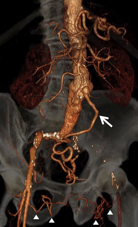 Three Dimensional Render From A Ct Angiogram Of The Abdominal Aorta