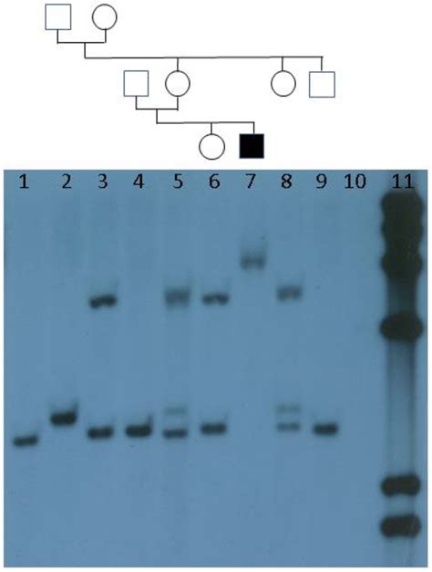 Fragile X Syndrome Southern Blot Analysis