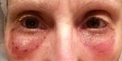 Blepharoplasty recovery pictures » Eyelid Surgery: Cost, Photos ...