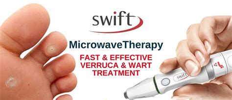 Verruca Microwave Therapy Thefoothutclinic Podiatrist