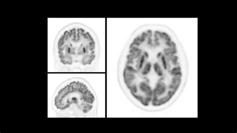 Beta Amyloid Pet Imaging For Alzheimers Disease