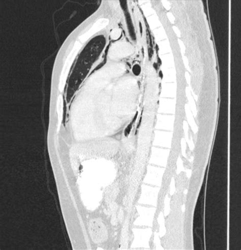 Better out than in: Spontaneous pneumomediastinum as a result of a ...