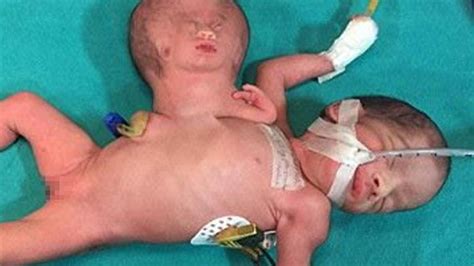 Bayi India Lahir Dengan Kembar Parasit Menempel Di Tubuhnya Citizen