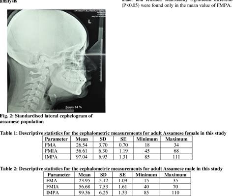 Figure 1 From Cephalometric Evaluation Of The Assamese Young Adults Using Tweeds Analysis