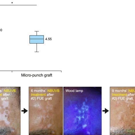 A Comparison Of Narrowband Ultraviolet B NBUVB Induced