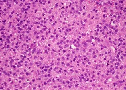 Primary Cns Lymphoma Histology Radiology Case Radiopaedia Org