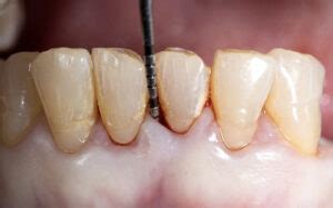 Root Surface Debridement Beyond Dental Health