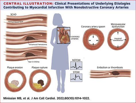 Ischemic Heart Disease In Young Women Jacc Review Topic Of The Week