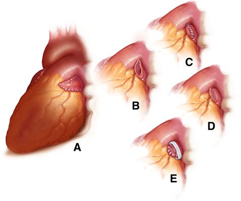 Time To Remove The Left Atrial Appendage At Surgery Laaos Iii In