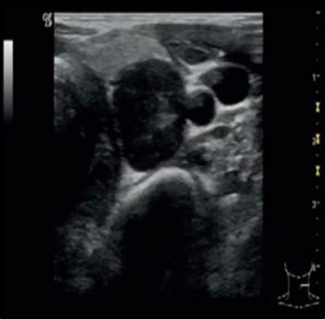 Frontiers Parathyroid Carcinoma All In One A Rare Life Threatening