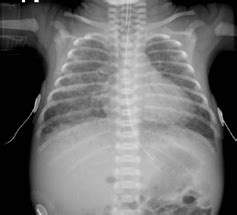 Distúrbios respiratórios do recém nascido o que é diagnóstico e