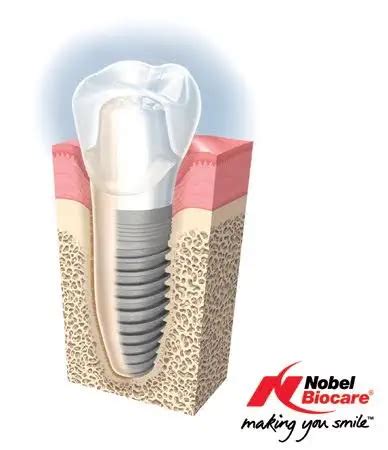 North York and Toronto Dental Implants | Wilson Dental