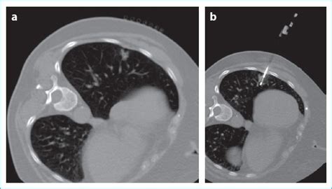 Computed Tomography Guided Transthoracic Core Needle Biopsy Of Lung