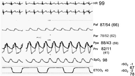 Inhaled Milrinone And Epoprostenol In A Patient With Severe Pulmonary