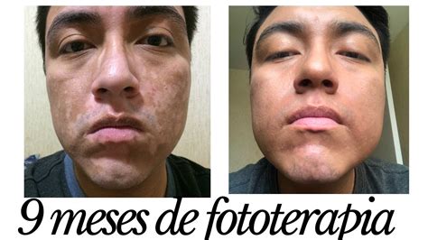 Fototerapia Antes E Depois - 9 MESES DE FOTOTERAPIA tratamiento para vitiligo 2019 - YouTube