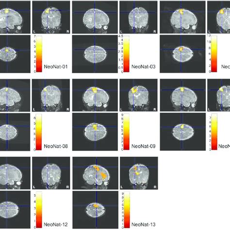 Activation Of The Sensorimotor Cortex Two Successive Fmri Runs With