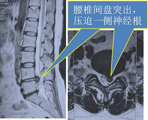 腰椎间盘突出症的症状、检查及治疗 腰椎间盘突出 症状表现 检查 治疗方式 好大夫在线