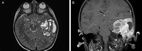 (A) Pre-operative MR images (axial T2 sequence): multiloculated osseous ...