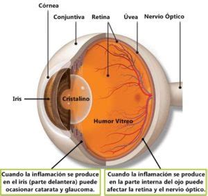 Uveítis tipos causas síntomas tratamiento Oftalmolima