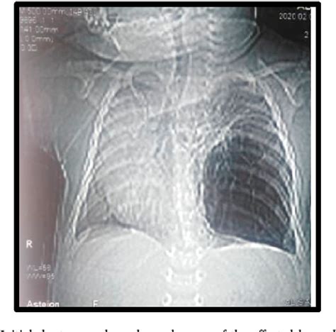 Figure 1 From A Rare Case Of Congenital Cystic Adenomatoid Malformation Mimics Pneumonia