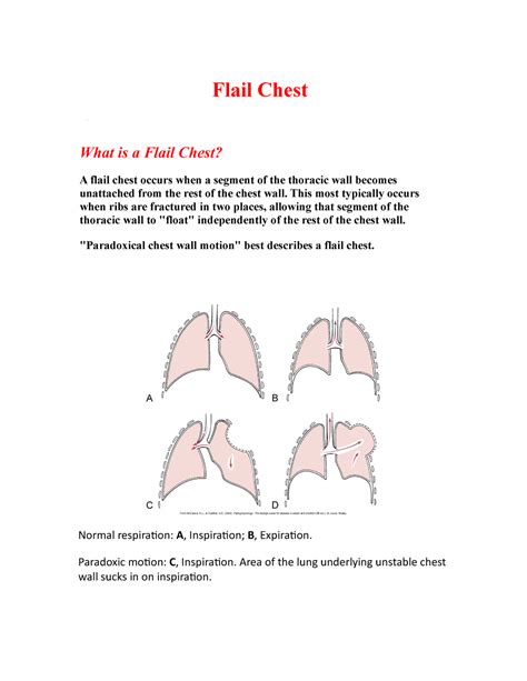 Flail Chest Informational Flail Chest What Is A Flail Chest A Flail Chest Occurs When A