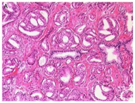 Cribriform Adenocarcinoma