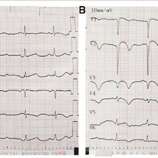 Emergency ECG showing de Winter ECG pattern | Download Scientific Diagram