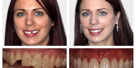 What Is The Difference Between Dentures And Veneers