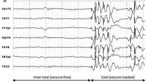 Figure 1 from High-performance detection of epilepsy in seizure-free ...