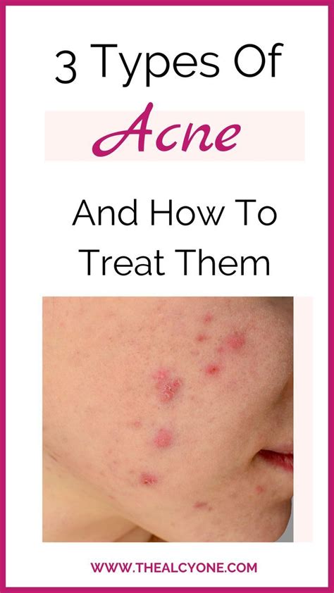 Top 10 Common Cause Of Acne And Treatments Artofit