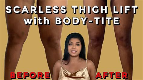 Scarless Thigh Lift Using Bodytite How I Melted Fat And Tightened My