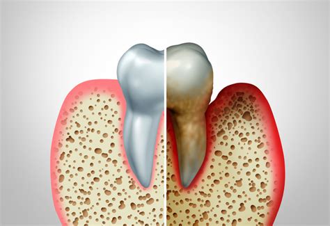 The Link Between Genetics And Periodontitis The Perio Group