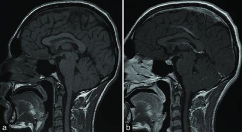 T1 Sagittal Section Of Hypothalamic Pituitary Mri Before A And After