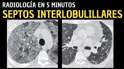 Radiolog A En Minutos Signos Radiol Gicos Pulmonares Septos