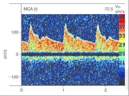 Doppler Spectrum And Envelope Curve Extracted By Insonation Of The