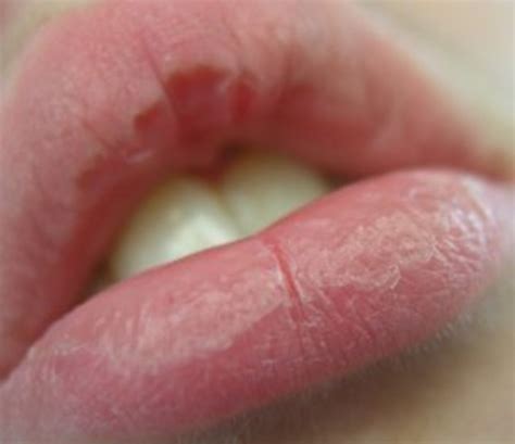 Extremely Dry Lips Is A Sign Of At Rita Davis Blog