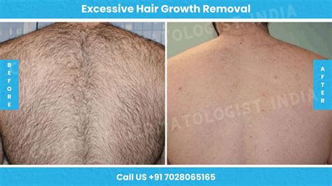 Hair Growth Removal Treatment Mumbai Hair Removal Laser Hair Removal Treatment Cost In India