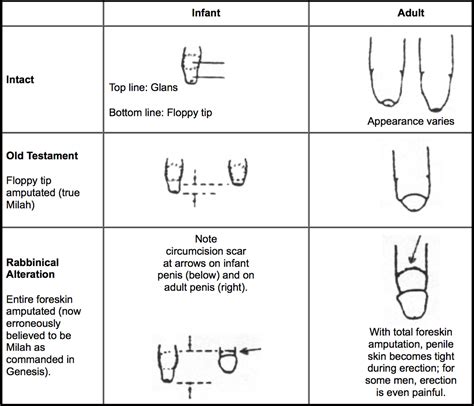 Circumcised Vs Uncircumcised Diagram How To Care For An Unci