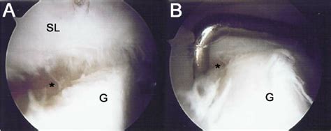 Two images of a type II SLAP tear in the same patient viewed from the... | Download Scientific ...