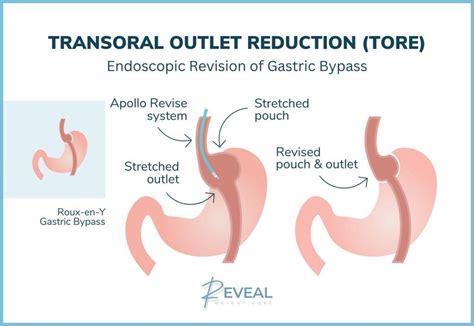 Gastric Bypass Revision In Livingston Nj Tore Procedure