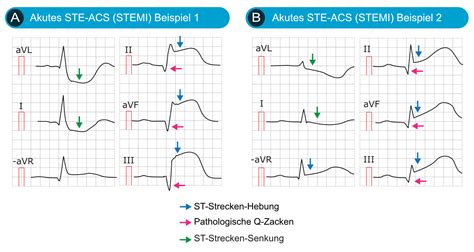 EKG Zeichen Eines Myokardinfarkt Pathologische Q Zacken