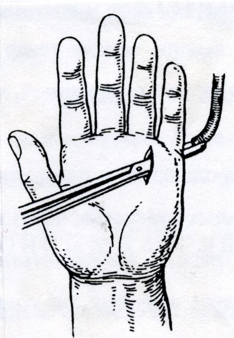 Флегмоны кисти