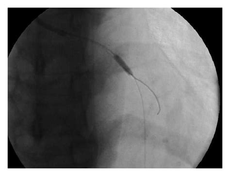 Aortic Stenosis Catheterization