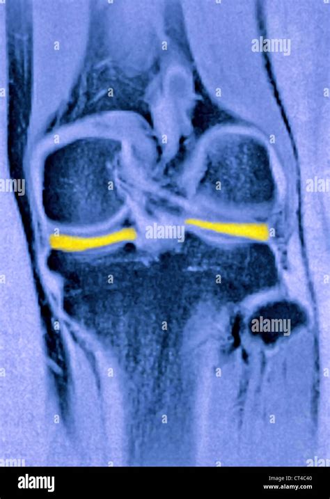 Normal mri knee Fotos und Bildmaterial in hoher Auflösung Alamy