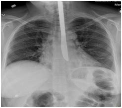 Treatment Of Acute Mediastinitis Secondary Traumatic Esophageal