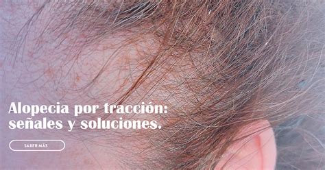 Alopecia Por Tracci N Es Posible Evitarla Meyer Alcaide